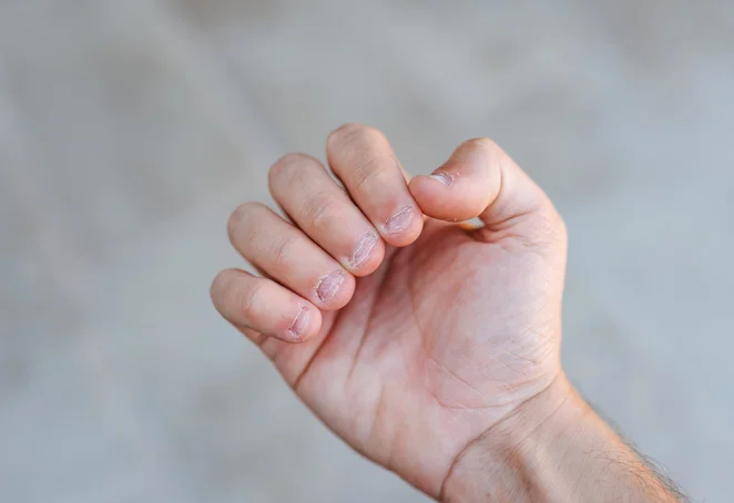 What is nail biting? Onychophagia causes & treatment